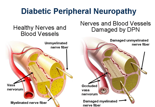 Peripheral Neuropathy Face Arms Legs 74